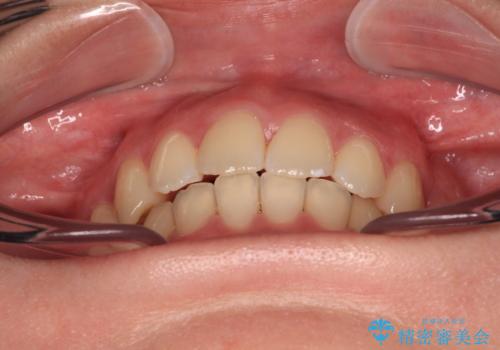 【モニター】横顔のシルエットをスッキリと ワイヤー装置による抜歯矯正治療の治療後