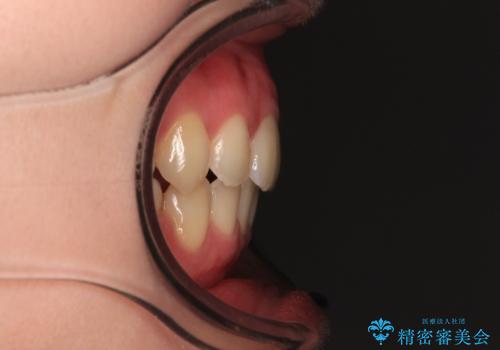 【モニター】横顔のシルエットをスッキリと ワイヤー装置による抜歯矯正治療の治療後