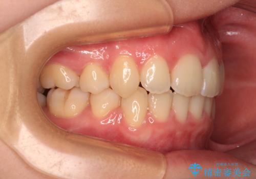 【モニター】横顔のシルエットをスッキリと ワイヤー装置による抜歯矯正治療の治療後