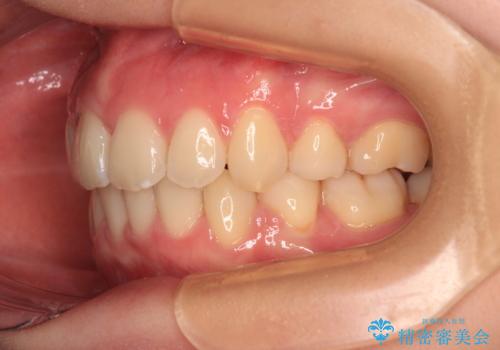 【モニター】横顔のシルエットをスッキリと ワイヤー装置による抜歯矯正治療の治療後