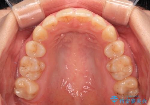 【モニター】横顔のシルエットをスッキリと ワイヤー装置による抜歯矯正治療の治療後