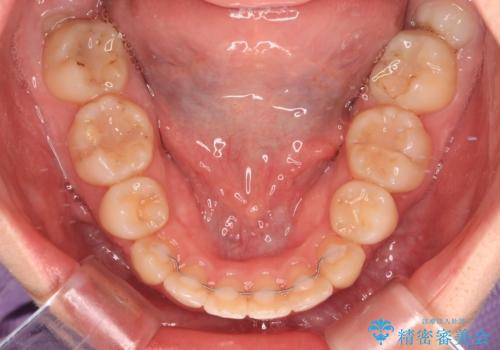 【モニター】横顔のシルエットをスッキリと ワイヤー装置による抜歯矯正治療の治療後