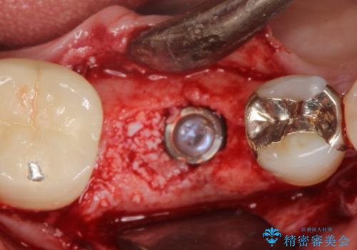 【インプラント】食事中に歯が割れた! かなり深いところまで歯が割れていたの治療中