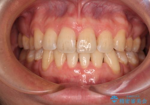 出っ歯と八重歯　目立たない裏側装置でスッキリとした口元にの症例 治療後