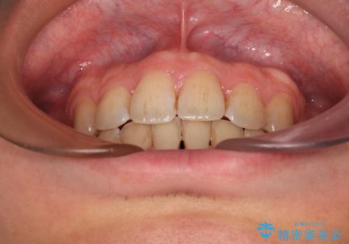 出っ歯と八重歯　目立たない裏側装置でスッキリとした口元にの治療後