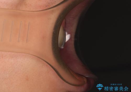 出っ歯と八重歯 目立たない裏側装置でスッキリとした口元にの治療後