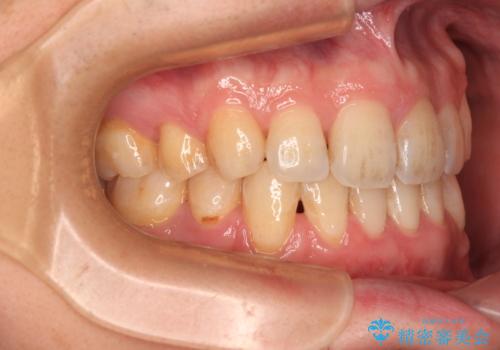 出っ歯と八重歯 目立たない裏側装置でスッキリとした口元にの治療後