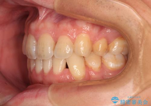 出っ歯と八重歯 目立たない裏側装置でスッキリとした口元にの治療後