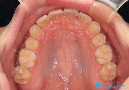 出っ歯と八重歯 目立たない裏側装置でスッキリとした口元にの治療後