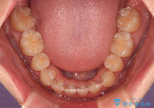 出っ歯と八重歯　目立たない裏側装置でスッキリとした口元にの治療後
