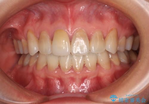 適合の悪い保険診療のクラウンをオールセラミッククラウンにの治療後