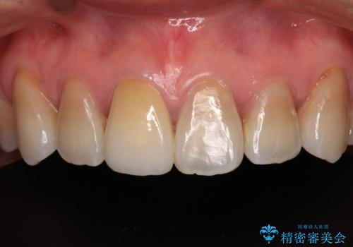 適合の悪い保険診療のクラウンをオールセラミッククラウンにの症例 治療後