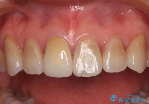 適合の悪い保険診療のクラウンをオールセラミッククラウンにの治療後