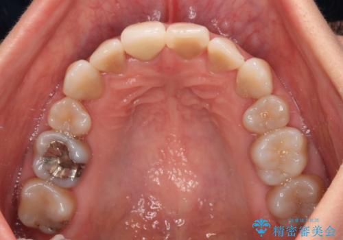 適合の悪い保険診療のクラウンをオールセラミッククラウンにの治療後
