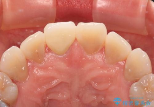適合の悪い保険診療のクラウンをオールセラミッククラウンにの治療後