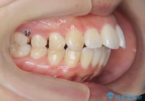 [ マウスピース矯正 ]  出っ歯に見える前歯を改善したいの治療中