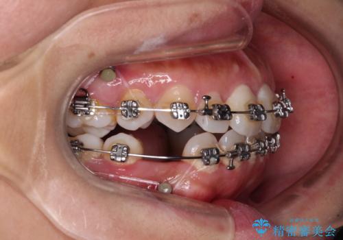 既に2本が抜歯されている歯列 咬み合わせのズレを改善する抜歯矯正の治療中