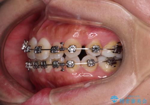 既に2本が抜歯されている歯列 咬み合わせのズレを改善する抜歯矯正の治療中
