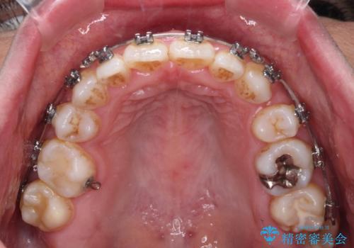 既に2本が抜歯されている歯列　咬み合わせのズレを改善する抜歯矯正の治療中