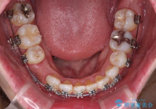 既に2本が抜歯されている歯列　咬み合わせのズレを改善する抜歯矯正の治療中