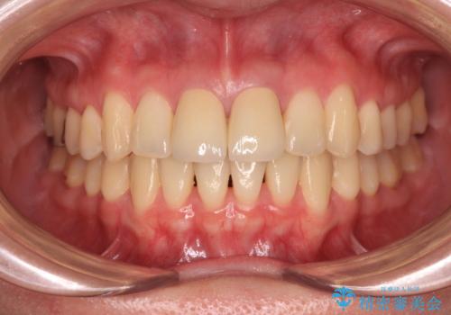 変色した前歯 オールセラミッククラウンにより審美歯科治療の治療後