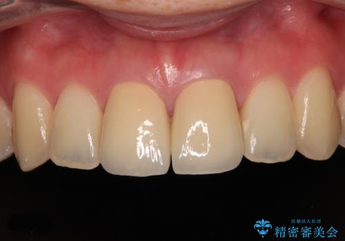 変色した前歯 オールセラミッククラウンにより審美歯科治療の症例 治療後