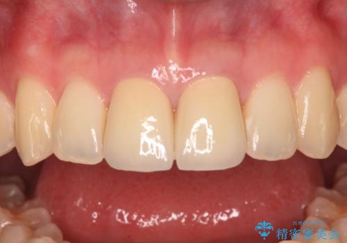 変色した前歯 オールセラミッククラウンにより審美歯科治療の治療後
