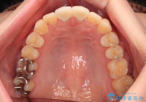 変色した前歯 オールセラミッククラウンにより審美歯科治療の治療後