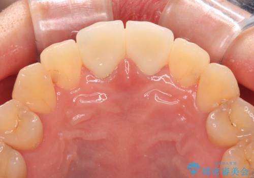 変色した前歯 オールセラミッククラウンにより審美歯科治療の治療後