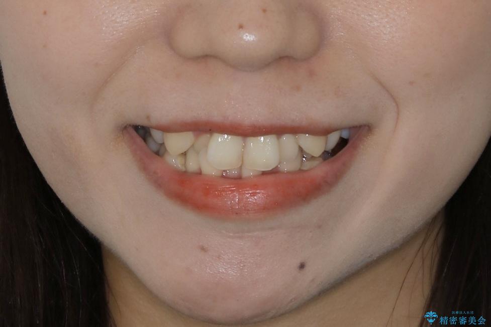 【抜歯】前歯のガタつきを改善　抜歯矯正で口腔内をスッキリさせるの治療前（顔貌）