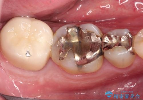 【インプラント】食事中に歯が割れた! かなり深いところまで歯が割れていたの治療前