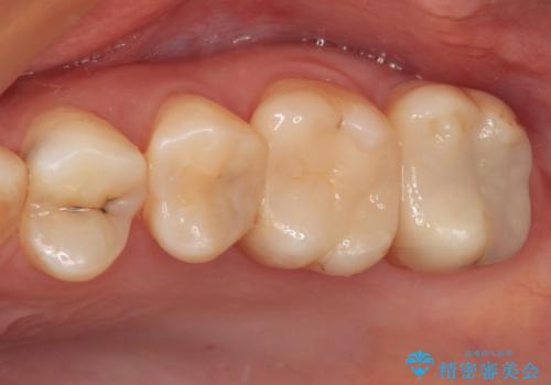 奥歯のむし歯治療　セラミックインレーの治療後
