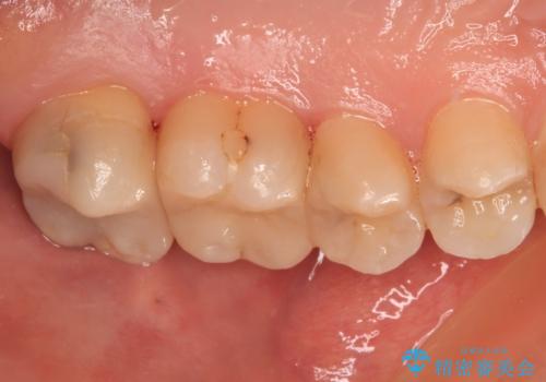 奥歯のむし歯治療 セラミックインレーの治療後