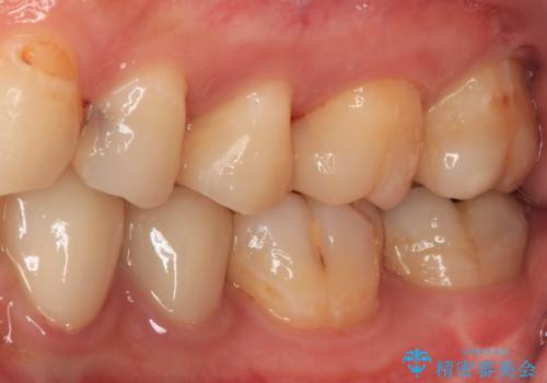 奥歯のむし歯治療 セラミックインレーの治療後