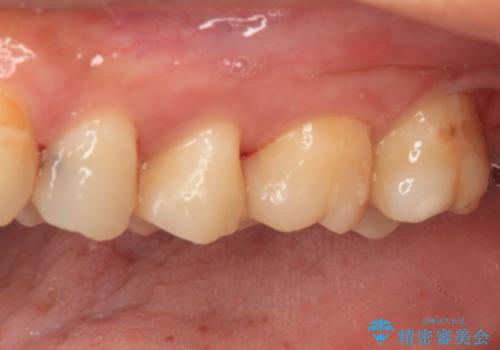 奥歯のむし歯治療 セラミックインレーの治療後