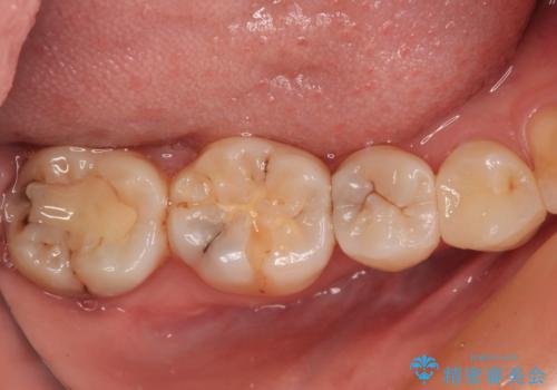 奥歯のむし歯治療　セラミックインレーの治療後