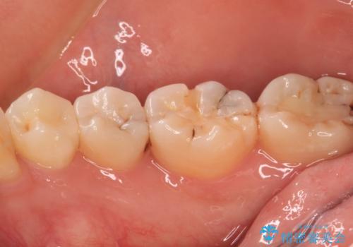 奥歯のむし歯治療 セラミックインレーの治療後