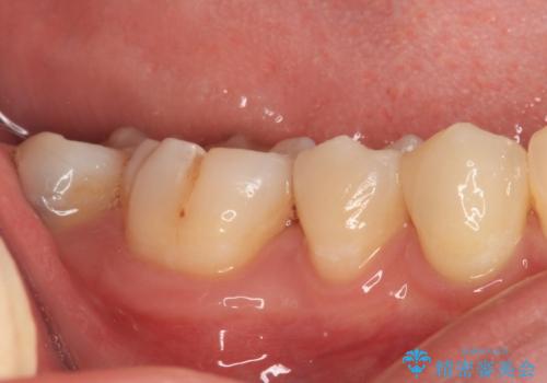 奥歯のむし歯治療 セラミックインレーの治療後