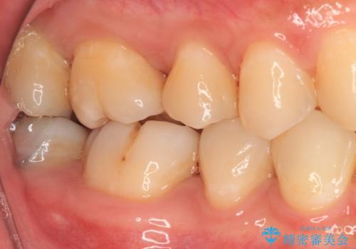 奥歯のむし歯治療 セラミックインレーの治療後