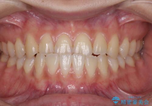 前歯のクロスバイトを治したい ワイヤー装置による矯正治療の治療前