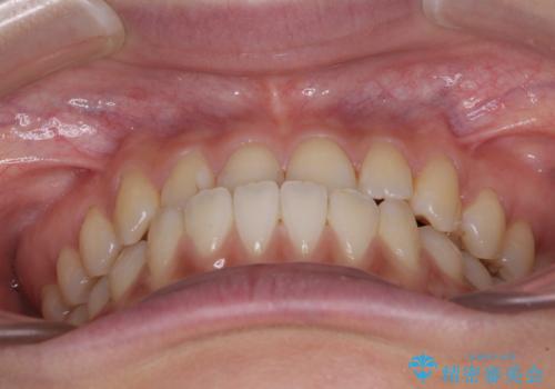 前歯のクロスバイトを治したい ワイヤー装置による矯正治療の治療前