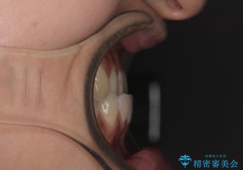 前歯のクロスバイトを治したい ワイヤー装置による矯正治療の治療前