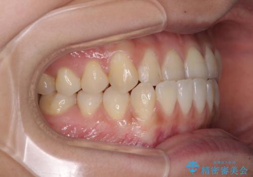 前歯のクロスバイトを治したい ワイヤー装置による矯正治療の治療前