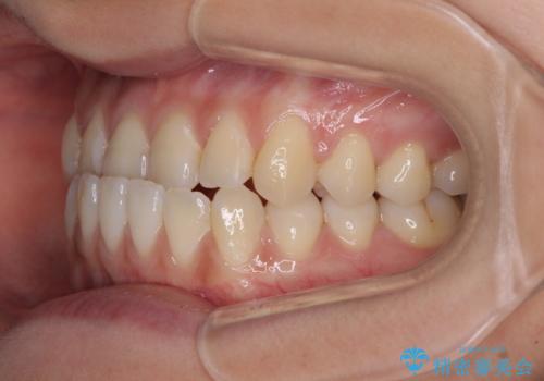 前歯のクロスバイトを治したい　ワイヤー装置による矯正治療の治療前