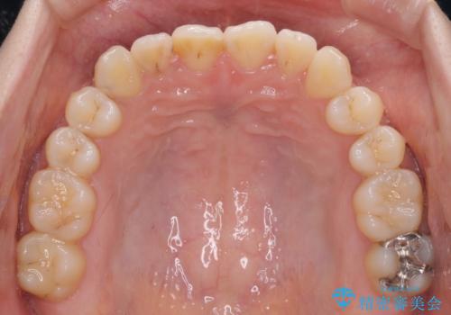 前歯のクロスバイトを治したい ワイヤー装置による矯正治療の治療前