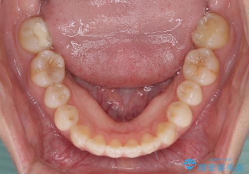 前歯のクロスバイトを治したい ワイヤー装置による矯正治療の治療前