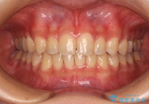 深い咬み合わせとデコボコの歯列をワイヤー矯正で改善の症例 治療後