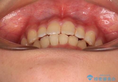 深い咬み合わせとデコボコの歯列をワイヤー矯正で改善の治療後
