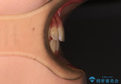 深い咬み合わせとデコボコの歯列をワイヤー矯正で改善の治療後