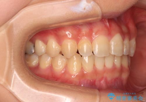 深い咬み合わせとデコボコの歯列をワイヤー矯正で改善の治療後